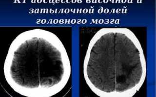 Абсцесс головного мозга (Церебральный абсцесс)